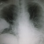 Diferencia entre neumonía y pulmonía